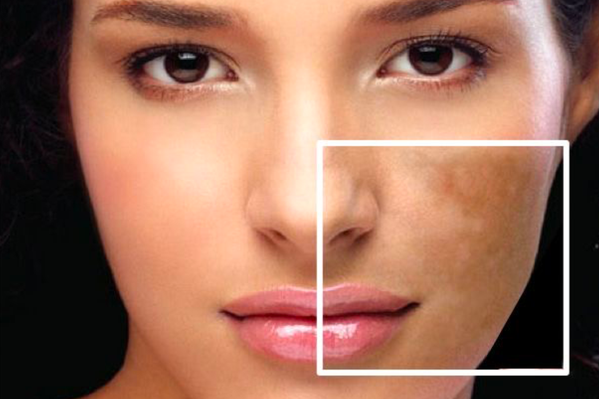 Laser Hyperpigmentation